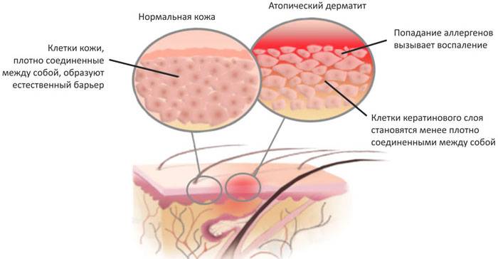 Атопический дерматит