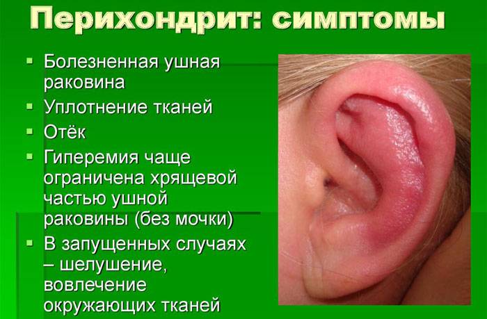 Симптомы перихондрита