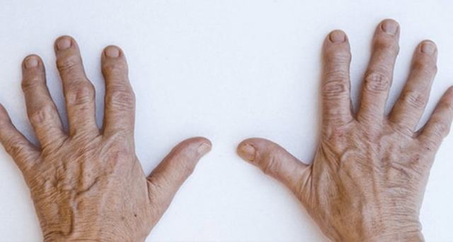Псориатическая артропатия: причины, симптомы, лечение