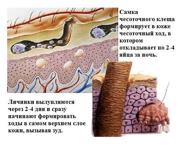 Сыпь на ладонях: высыпания в виде пузырьков, лечение