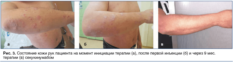 Рис. 3. Состояние кожи рук пациента на момент инициации терапии (а), после первой инъекции (б) и через 9 мес. терапии (в) секукинумабом