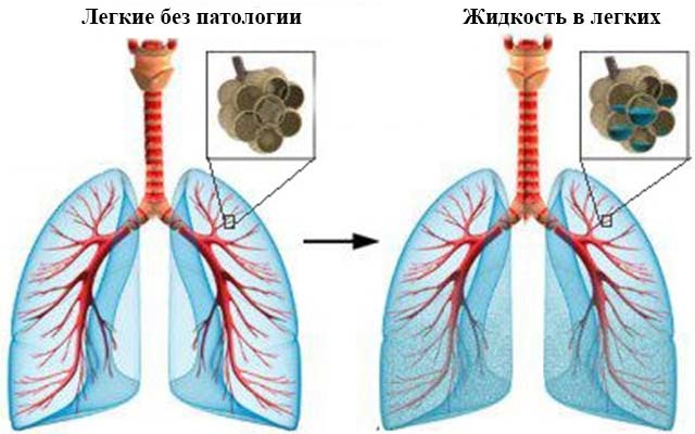Сколько живут с водой в легких – прогноз