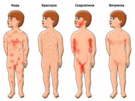 От чего появляется сыпь похожая на укусы комаров и как она выглядет