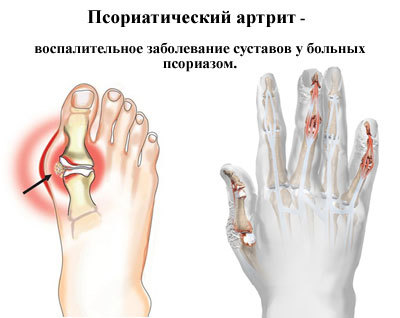 Псориатический артрит: симптомы, лечение, фото, диагностика