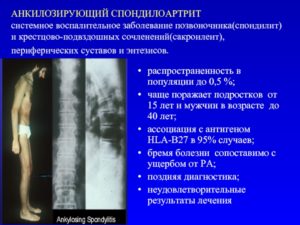 Периферический спондилоартрит лечение