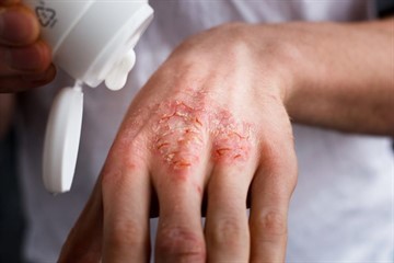 Диабет и псориаз: симптомы, причины, лечение, профилактика