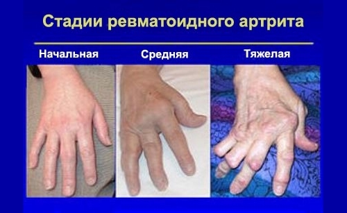 Инвалидность при артрите ревматоидного и псориатического вида