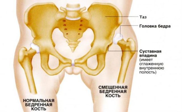 Боль на внутренней стороне бедра – причины и лечение