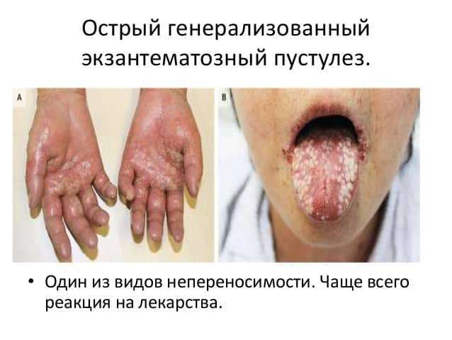 Генерализованный пустулезный псориаз Цумбуша: причины, симптомы, лечение