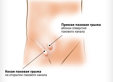 Боль на внутренней стороне бедра – причины и лечение
