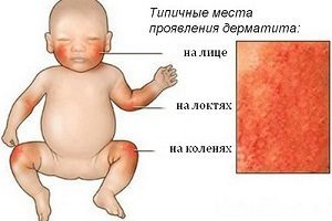 Сыпь на ладонях: высыпания в виде пузырьков, лечение