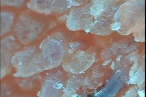 Себорейный дерматит