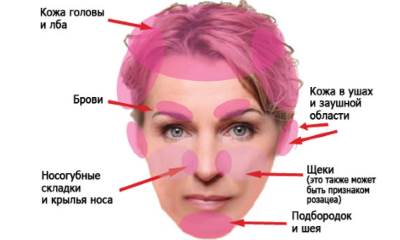 Себорейный псориаз: фото и лечение волосистой части головы