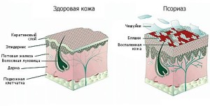 Псориаз