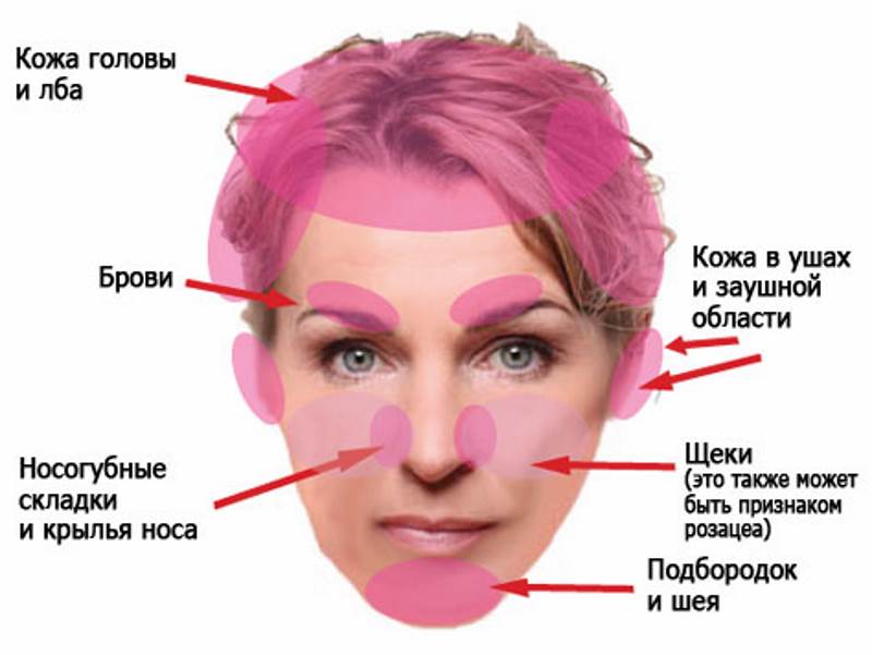 Псориаз или себорейный дерматит