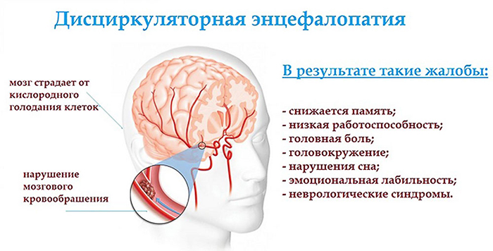Дисциркуляторная энцефалопатия