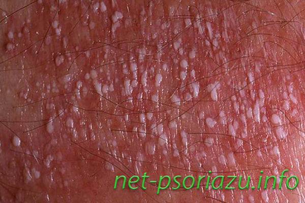 Экссудативная форма псориаза