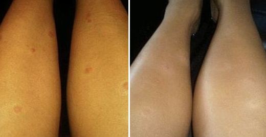 Inderma от псориаза до и после
