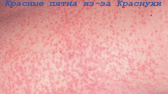 Красные пятна из-за Краснухи