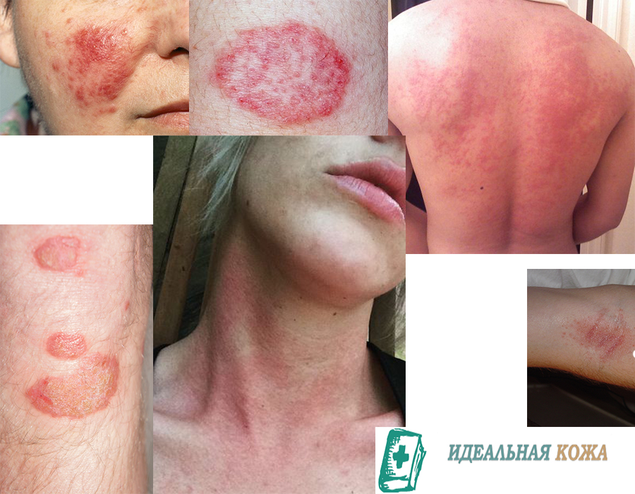 Красные пятна на теле у взрослых и детей