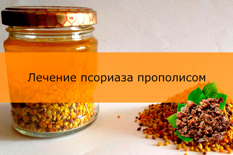 Прополис при псориазе: рецепт, лечение, отзывы