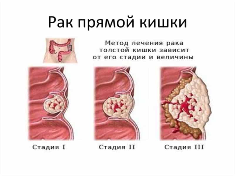 Сколько живут с раком прямой кишки на 3 стадии: подробный прогноз