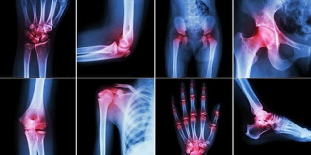 Причины появления полиартрита довольно разнообразны и зависят от первичного заболевания, выявить которое бывает сложно