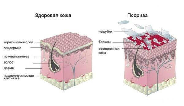 Псориаз