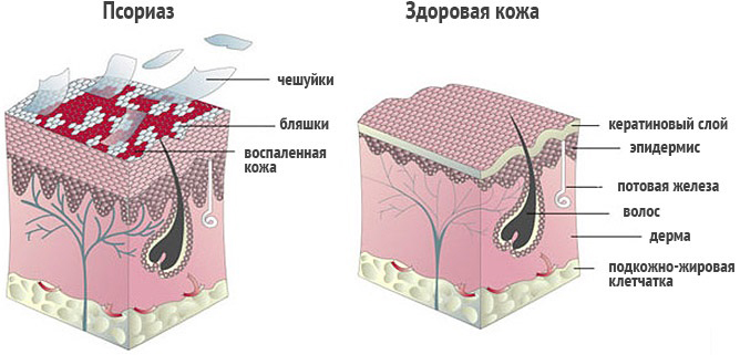 Псориаз и здоровая кожа