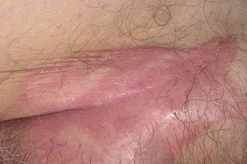 Локальное поражение псориазом
