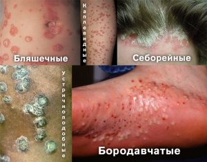 Разновидности высыпаний