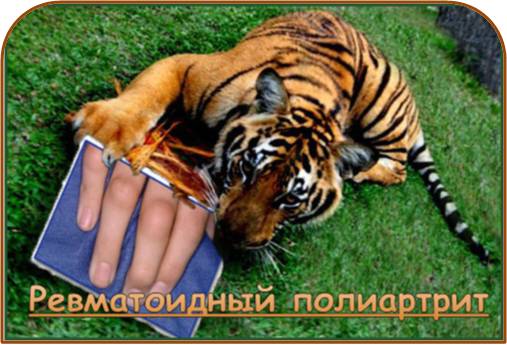 Ревматоидный полиартрит