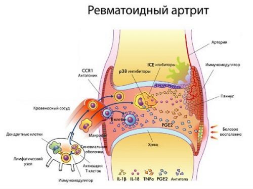 Ревматоидный артрит