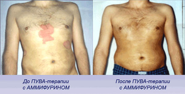 Результаты ПУВА-терапии с Аммифурином