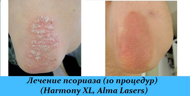 Результаты лазеротерапии после 10 процедур
