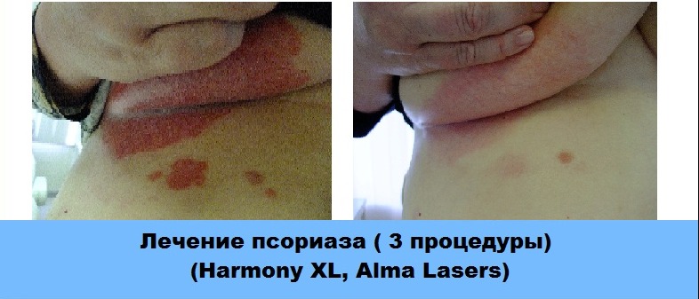 Результаты лазеротерапии после 3 процедур