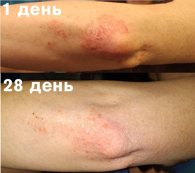 Результаты лечения