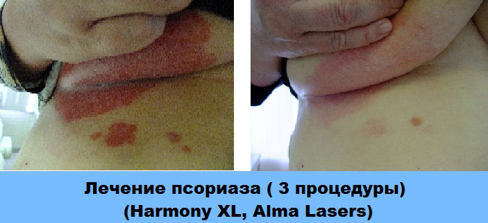 Результаты лечения лазером