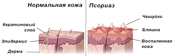 Проявление псориаза
