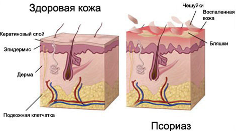 Схема псориаза кожи