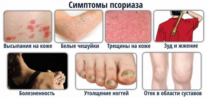 Симптомы псориаза
