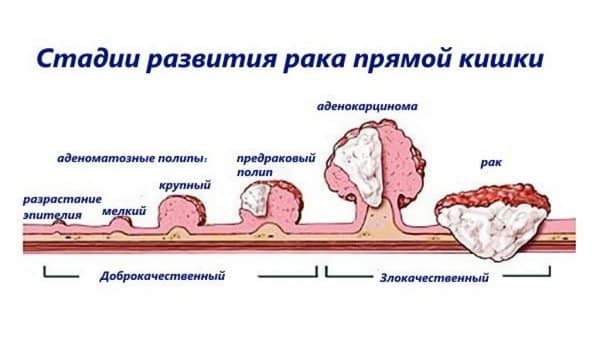 Сколько живут с раком прямой кишки на 3 стадии: подробный прогноз