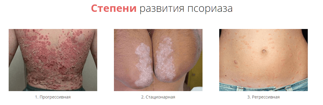 Степени развития псориаза