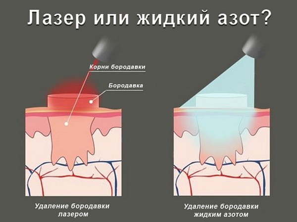 Удаление бородавок