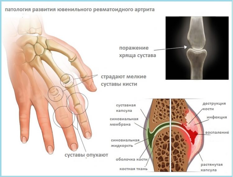 Как развивается патология