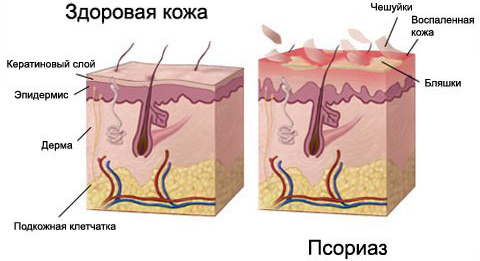 Здоровая кожа и псориаз