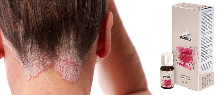 Psorix от псориаза: комплекс для естественного избавления от болезни, ее причин и симптомов!
