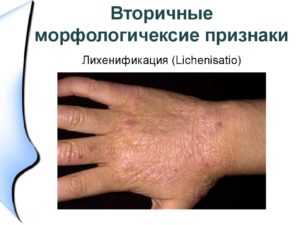 Распространенный атопический дерматит с очаговой лихенификацией