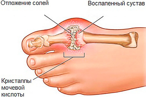 О чем говорят показатели содержания мочевой кислоты в крови?
