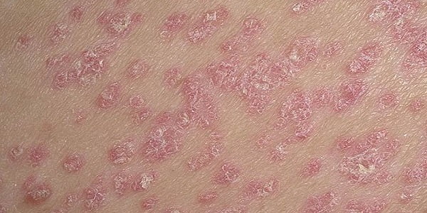 Что делать если у ребенка трескается и шелушится кожа на ногах